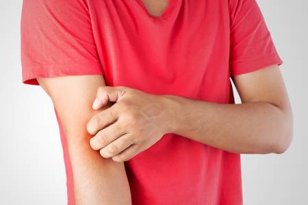 Eczema may signal higher risk of cardiovascular problems